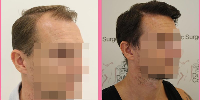 Hair transplant before and after at Hair Transplant Dubai, Umm Suqeim