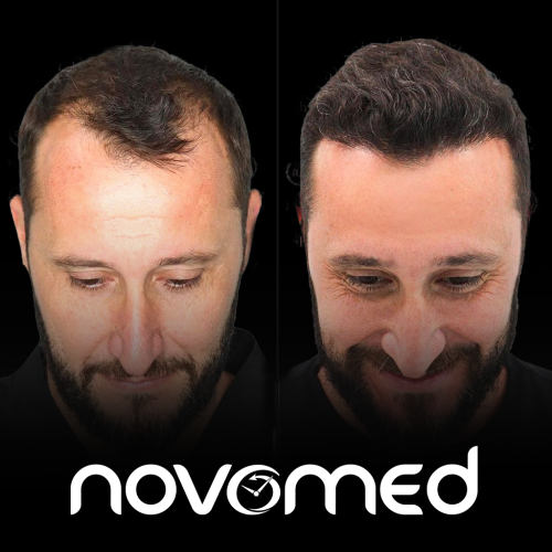 FUE hair transplant result at Novomed, Dubai