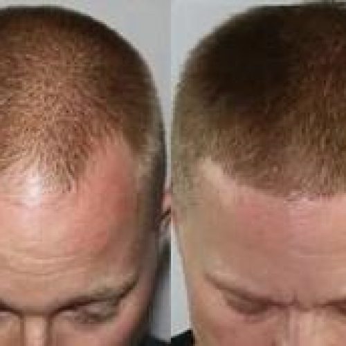 FUE hair transplant clinic at Glamorous Clinic, Dubai
