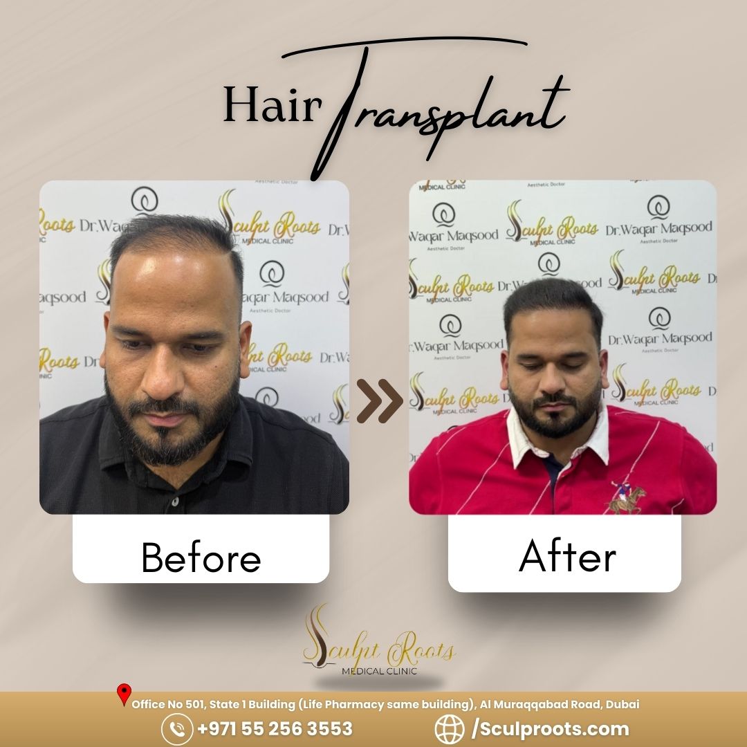 Hair transplant result at Sculpt Roots Medical Clinic, Dubai