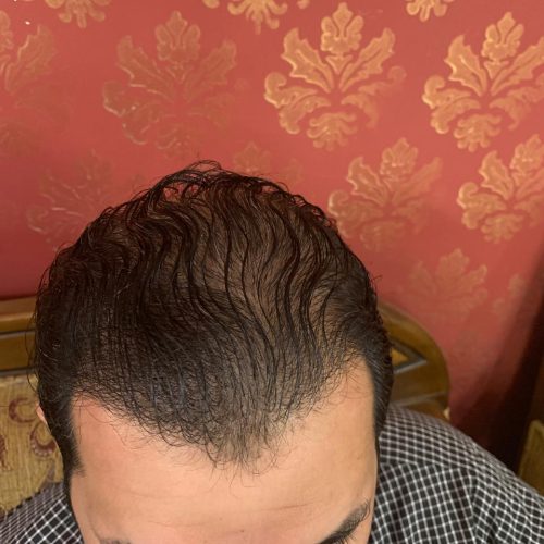 Hairline after hair transplant at Alborj Hair Clinic, Dubai