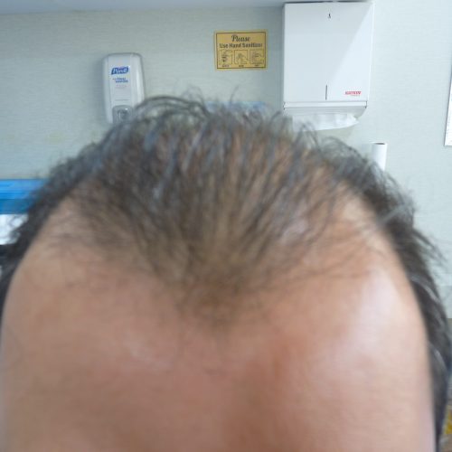 Hairline before hair transplant at Alborj Hair Clinic, Dubai