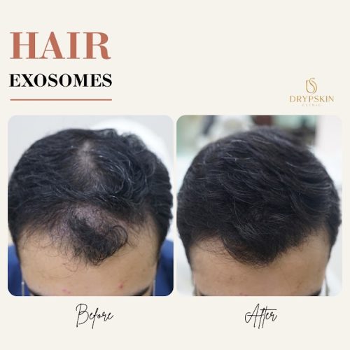 Hair treatment before and after at DrypSkin, Dubai Marina