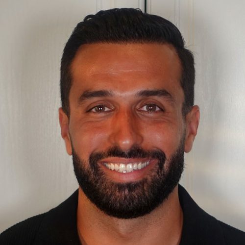 Hair transplant result one year after surgery at Hair Clinic Dubai