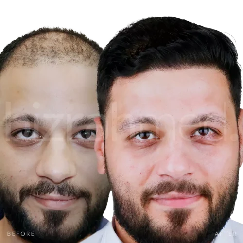 Hair transplant before and after at Bizrahmed, Dubai